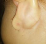 Уплотнение в мочке уха фото 1