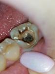 Зуб, боль, временная пломба фото 1