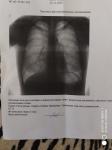 Фиброзные изменения после пневмонии, что делать фото 1
