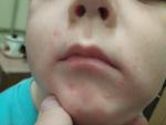 Помогите пожалуйста определить что за сыпь на лице у ребенка фото 1