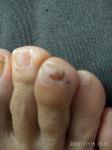 Тромбоциты низкие, пятно под ногтем, болезненность справа в районе кишечника фото 1