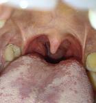 Увеличена миндалина с правой стороны фото 1