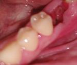 Внутри зуба разрастается ткань фото 1