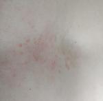 Красные пятнышки на груди в виде сыпи фото 3