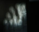 Трещина третьего пальца ноги фото 1