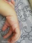 Красная сыпь на руках у ребенка фото 5