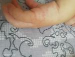 Красная сыпь на руках у ребенка фото 3