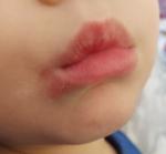 Ребенок 4 года пятно около рта, не проходит, становится больше фото 1