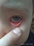 Сухость глаз у маленького ребенка фото 1