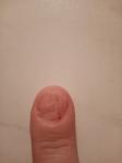 Механическое повреждение ногтевой пластины фото 1