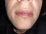 Опухоли губы, болит полость рта фото 1