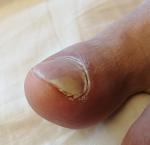 Отслойка ногтя на ноге фото 1