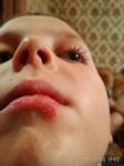 Не заживает болячка на губе у ребенка фото 1