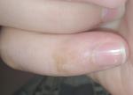 Коричневое пятно на пальце фото 1