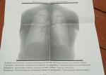 Прикорневой пневмосклероз фото 1