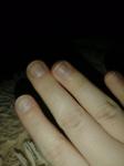 Странный цвет ногтевой пластины фото 1