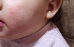 Красная сыпь на щеках ребенка, запах изо рта фото 1