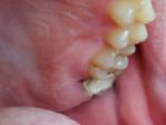 Странная проблема с десной или зубом фото 3