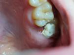 Странная проблема с десной или зубом фото 1