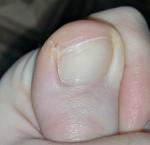 Пятно рядом с ногтем большого пальца ноги фото 2