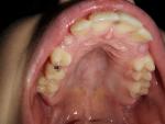 Кариес молочного зуба фото 2