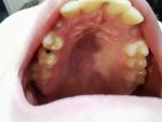 Кариес молочного зуба фото 1