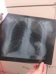 Поставили диагноз по снимку туберкулез фото 1