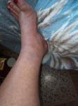 Покраснела нога хромота при фото 4