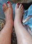 Покраснела нога хромота при фото 3