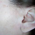 Шелушение кожи в ушной раковине фото 2