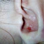 Шелушение кожи в ушной раковине фото 1