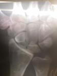 Перелом ладьевидной кости фото 2