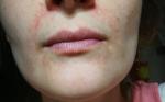 Хроническое покраснение кожи вокруг рта фото 2