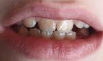 Потемнение эмали зубов фото 1