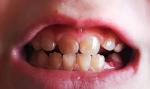 Потемнение эмали зубов фото 2
