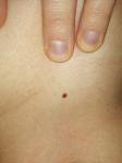 Странная родинка с чёрными вкраплениями фото 2