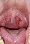 Боль и покраснение в горле, уместен ли антибиотик? фото 1