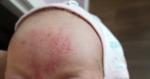 Сыпь на лбу у новорожденного фото 1
