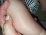 Пятнышки на ноге у ребенка фото 1