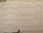 Расшифровка ЭКГ (боль и тяжесть за грудиной) фото 1