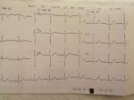 Расшифровка ЭКГ (боль и тяжесть за грудиной) фото 2