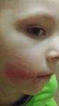 Красное пятно на лице у ребёнка фото 1