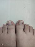 Тёмные пятна симметрично на ногтях ног фото 1