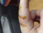 Опух палец после травмы фото 2