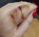 Опух палец после травмы фото 1
