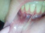 Болячка внутри губы фото 1