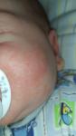 Сыпь на лице у новорожденного фото 3