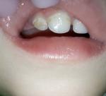 Испортились зубы у маленького ребенка фото 2