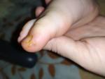 Непонятное шелешение пальца ногтя ноги фото 1