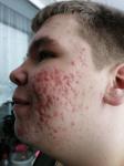 Воспаление на лице у подростка фото 1